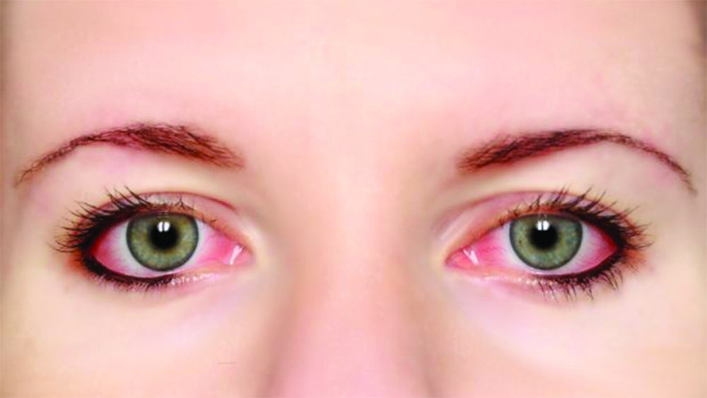 efek samping penggunaan softlens
