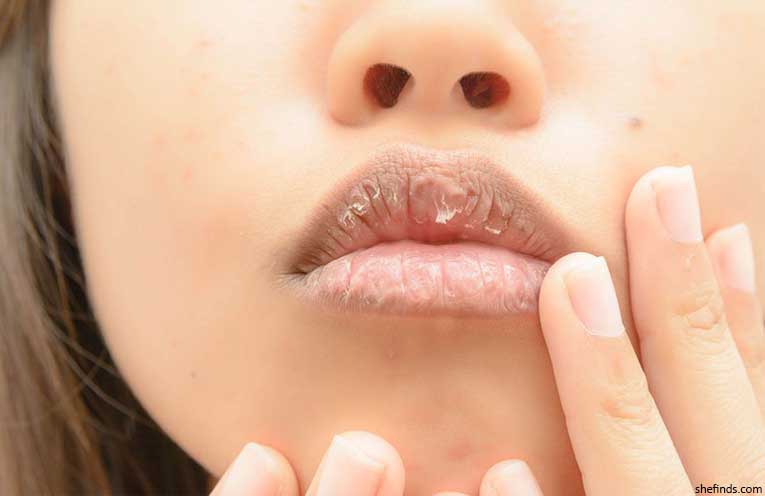 bibir kering